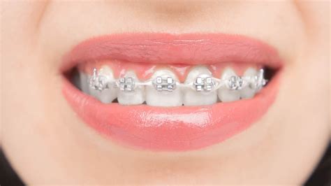 cuales son mejores los brackets metalicos o esteticos|brackets invisibles precio.